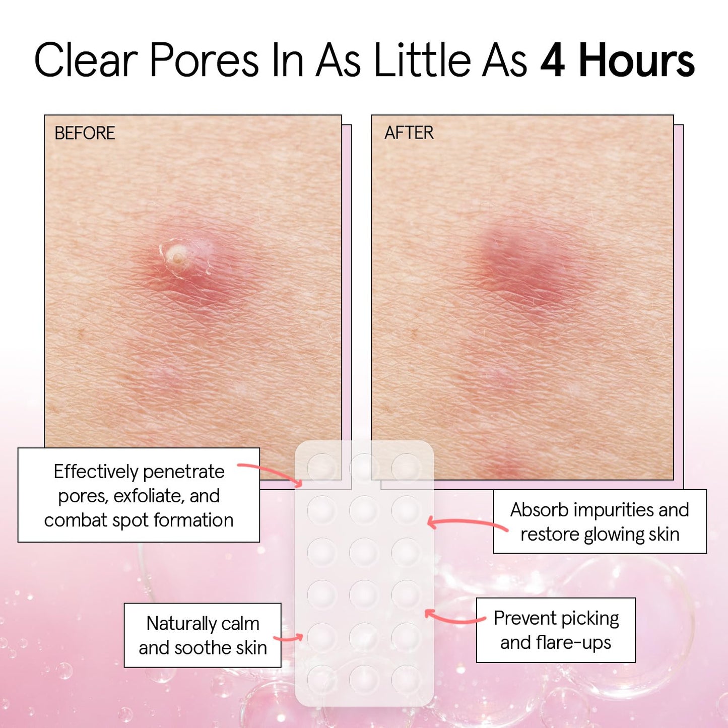 Hydrocolloid Clear Pimple Patches - Bajo Pedido